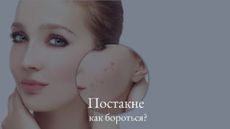 как победить постакне